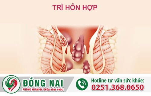 Trĩ hỗn hợp là gì?